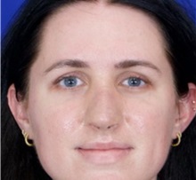 Rhinoplasty After Photo by Thanapoom Boonipat, MD; Lubbock, TX - Case 51503