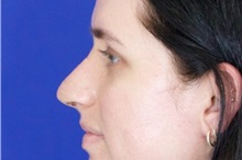 Rhinoplasty After Photo by Thanapoom Boonipat, MD; Lubbock, TX - Case 51503
