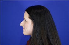 Rhinoplasty Before Photo by Thanapoom Boonipat, MD; Lubbock, TX - Case 51503