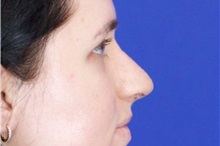 Rhinoplasty After Photo by Thanapoom Boonipat, MD; Lubbock, TX - Case 51503