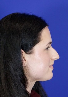 Rhinoplasty Before Photo by Thanapoom Boonipat, MD; Lubbock, TX - Case 51503