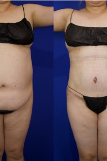 Tummy Tuck After Photo by Thanapoom Boonipat, MD; Lubbock, TX - Case 51512