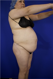 Tummy Tuck Before Photo by Thanapoom Boonipat, MD; Lubbock, TX - Case 51512