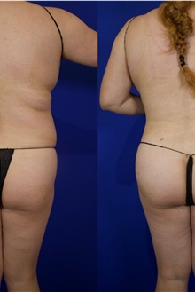 Tummy Tuck After Photo by Thanapoom Boonipat, MD; Lubbock, TX - Case 51512