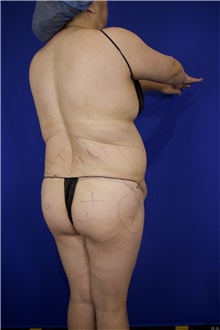 Tummy Tuck Before Photo by Thanapoom Boonipat, MD; Lubbock, TX - Case 51512