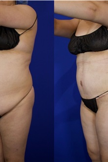 Tummy Tuck After Photo by Thanapoom Boonipat, MD; Lubbock, TX - Case 51512