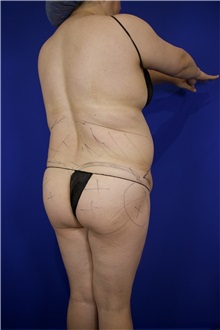 Tummy Tuck Before Photo by Thanapoom Boonipat, MD; Lubbock, TX - Case 51512