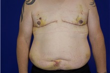 Male Breast Reduction After Photo by Thanapoom Boonipat, MD; Lubbock, TX - Case 51500