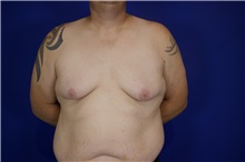 Male Breast Reduction Before Photo by Thanapoom Boonipat, MD; Lubbock, TX - Case 51500