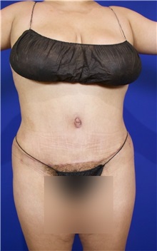 Tummy Tuck After Photo by Thanapoom Boonipat, MD; Lubbock, TX - Case 51510
