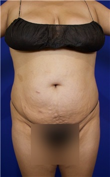 Tummy Tuck Before Photo by Thanapoom Boonipat, MD; Lubbock, TX - Case 51510