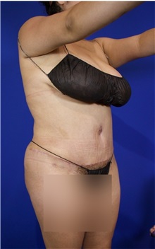Tummy Tuck After Photo by Thanapoom Boonipat, MD; Lubbock, TX - Case 51510