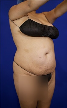 Tummy Tuck Before Photo by Thanapoom Boonipat, MD; Lubbock, TX - Case 51510