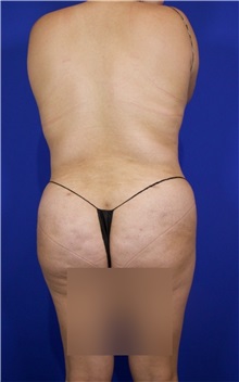 Tummy Tuck After Photo by Thanapoom Boonipat, MD; Lubbock, TX - Case 51510