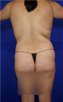 Tummy Tuck Before Photo by Thanapoom Boonipat, MD; Lubbock, TX - Case 51510