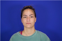 Rhinoplasty Before Photo by Thanapoom Boonipat, MD; Lubbock, TX - Case 51511
