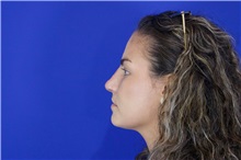 Rhinoplasty After Photo by Thanapoom Boonipat, MD; Lubbock, TX - Case 51511