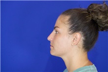 Rhinoplasty Before Photo by Thanapoom Boonipat, MD; Lubbock, TX - Case 51511