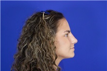 Rhinoplasty After Photo by Thanapoom Boonipat, MD; Lubbock, TX - Case 51511