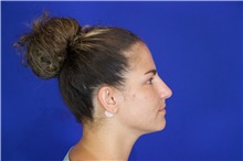 Rhinoplasty Before Photo by Thanapoom Boonipat, MD; Lubbock, TX - Case 51511