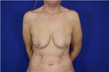 Breast Augmentation Before Photo by Thanapoom Boonipat, MD; Lubbock, TX - Case 51514