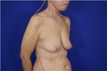 Breast Augmentation Before Photo by Thanapoom Boonipat, MD; Lubbock, TX - Case 51514