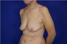 Breast Augmentation Before Photo by Thanapoom Boonipat, MD; Lubbock, TX - Case 51514