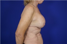 Breast Augmentation After Photo by Thanapoom Boonipat, MD; Lubbock, TX - Case 51514