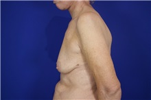 Breast Augmentation Before Photo by Thanapoom Boonipat, MD; Lubbock, TX - Case 51514