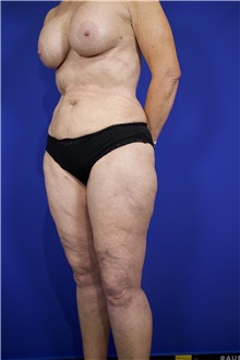 Liposuction After Photo by Thanapoom Boonipat, MD; Lubbock, TX - Case 51515