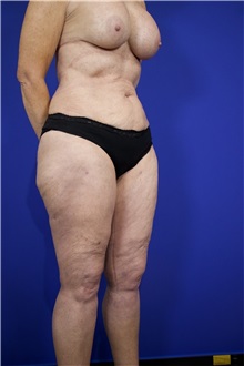 Liposuction After Photo by Thanapoom Boonipat, MD; Lubbock, TX - Case 51515