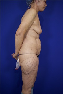 Liposuction Before Photo by Thanapoom Boonipat, MD; Lubbock, TX - Case 51515
