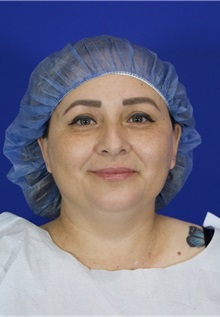 Eyelid Surgery Before Photo by Thanapoom Boonipat, MD; Lubbock, TX - Case 51516