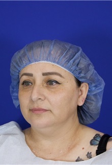 Eyelid Surgery Before Photo by Thanapoom Boonipat, MD; Lubbock, TX - Case 51516