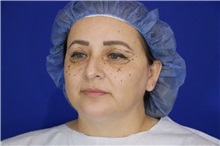 Eyelid Surgery Before Photo by Thanapoom Boonipat, MD; Lubbock, TX - Case 51518