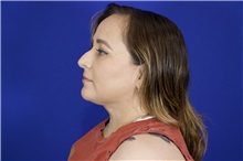 Eyelid Surgery After Photo by Thanapoom Boonipat, MD; Lubbock, TX - Case 51524