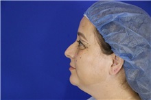 Eyelid Surgery Before Photo by Thanapoom Boonipat, MD; Lubbock, TX - Case 51524