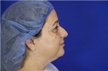 Eyelid Surgery Before Photo by Thanapoom Boonipat, MD; Lubbock, TX - Case 51523