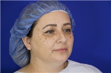 Eyelid Surgery Before Photo by Thanapoom Boonipat, MD; Lubbock, TX - Case 51525