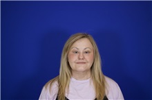 Eyelid Surgery After Photo by Thanapoom Boonipat, MD; Lubbock, TX - Case 51531