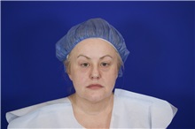 Eyelid Surgery Before Photo by Thanapoom Boonipat, MD; Lubbock, TX - Case 51531
