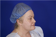 Eyelid Surgery Before Photo by Thanapoom Boonipat, MD; Lubbock, TX - Case 51531