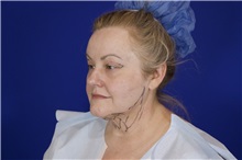 Eyelid Surgery Before Photo by Thanapoom Boonipat, MD; Lubbock, TX - Case 51531