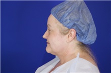 Eyelid Surgery Before Photo by Thanapoom Boonipat, MD; Lubbock, TX - Case 51531