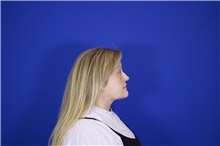 Eyelid Surgery After Photo by Thanapoom Boonipat, MD; Lubbock, TX - Case 51531