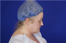 Eyelid Surgery Before Photo by Thanapoom Boonipat, MD; Lubbock, TX - Case 51531