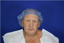 Eyelid Surgery Before Photo by Thanapoom Boonipat, MD; Lubbock, TX - Case 51551