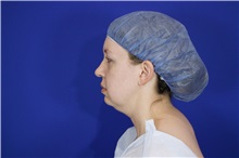 Liposuction Before Photo by Thanapoom Boonipat, MD; Lubbock, TX - Case 51552