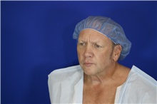 Eyelid Surgery Before Photo by Thanapoom Boonipat, MD; Lubbock, TX - Case 51555