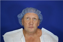 Eyelid Surgery Before Photo by Thanapoom Boonipat, MD; Lubbock, TX - Case 51553